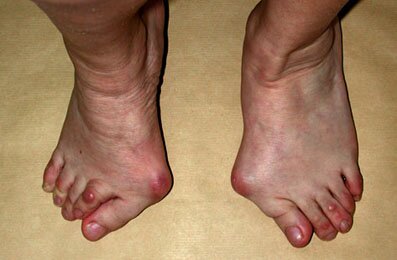 hallux-valgus-1